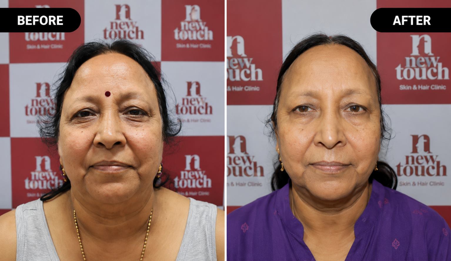 Treatment Results
