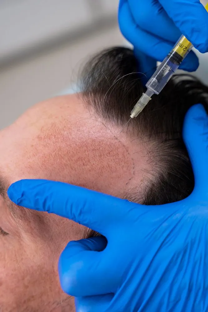Hair Transplant