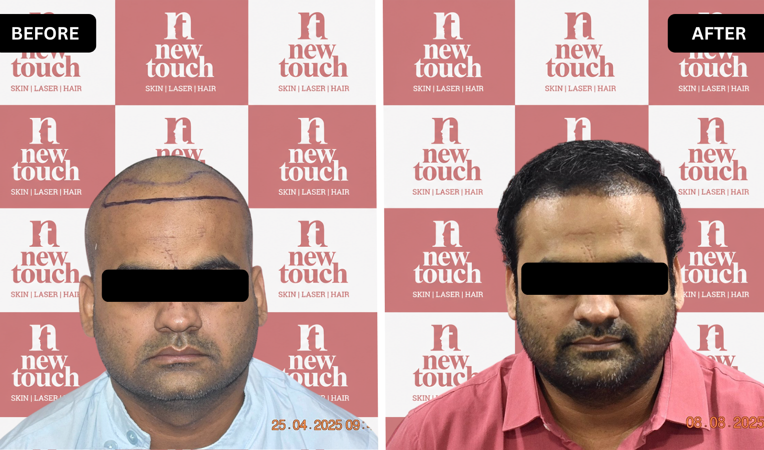 Treatment Result