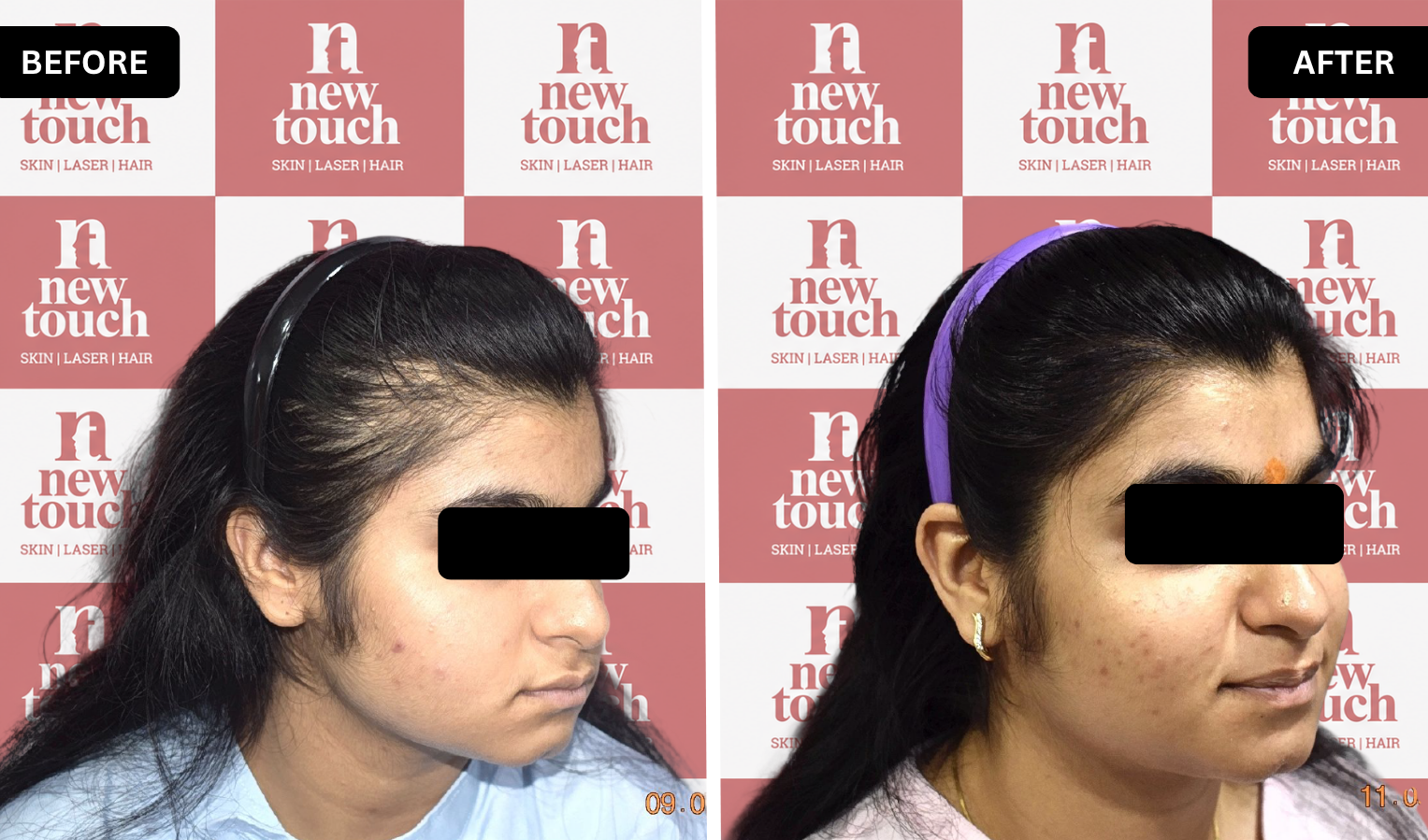 Before and after treatment